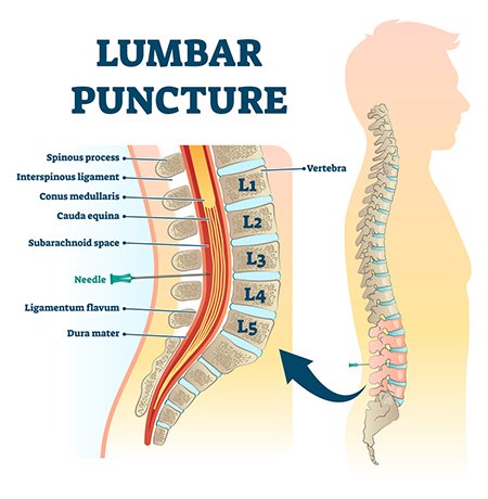 Lumbar Puncture