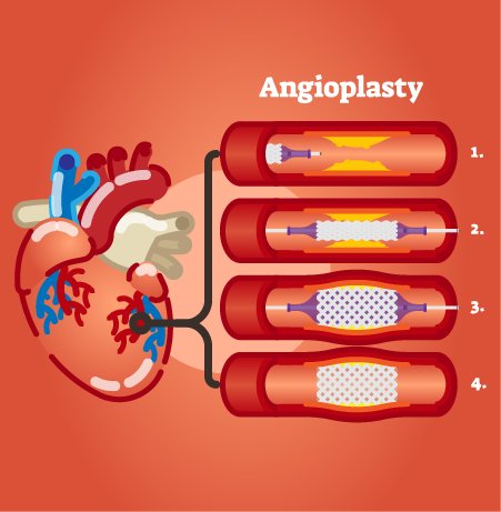 Angioplasty